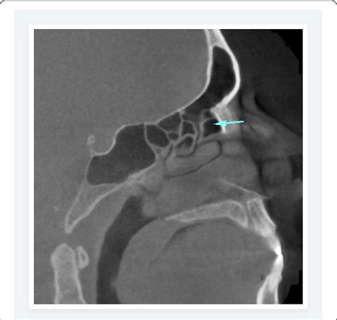 Sagittal CBCT Plane Showing Agger Nasi Cell Arrow And Its Relation