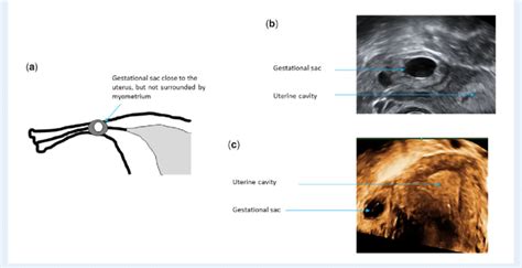 Isthmic Tubal Ectopic Pregnancy A Schematic Diagram B 2d Download Scientific Diagram