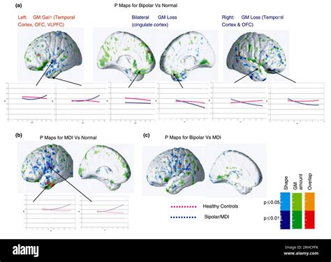 Brain Development Before And After Paediatric Bipolar Disorder Mri