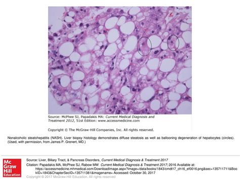 Nonalcoholic Steatohepatitis Nash Ppt Download