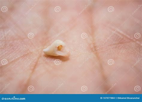 A Baby Tooth Drop From The Mouth Stock Photo Image Of Care Broken