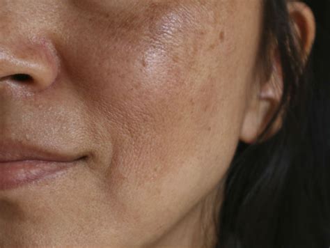 Cosméticos para el melasma los mejores ingredientes activos para