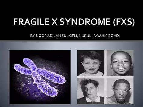 Ppt Fragile X Syndrome Fxs Powerpoint Presentation Free Download