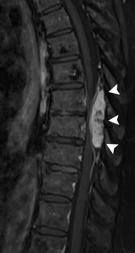 Thoracic Spinal Epidural Capillo Cavernous Hemangioma Causing Back Pain