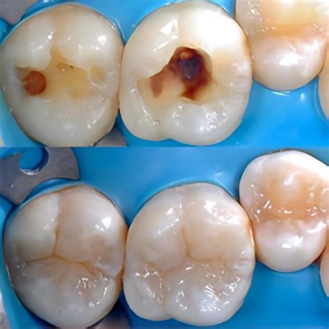 ODONTOLOGÍA RESTAURATIVA Dr Alejandro Martinez