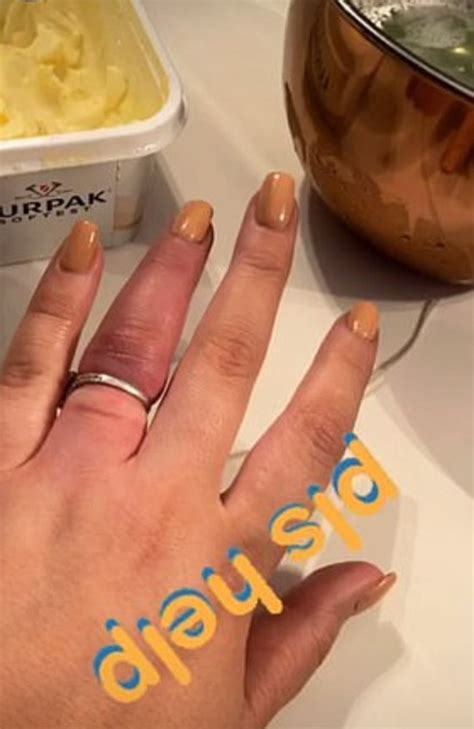 Woman Has 898k Engagement Ring Cut Off Her Swollen Finger