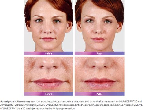 Fillers Dermatologist In Santa Monica Ca