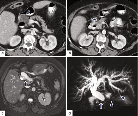 Pancreatic Ductal Adenocarcinoma Pdac Radiology Key