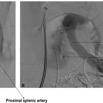 Digital Subtraction Angiography Images Lateral Oblique And