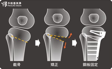 退化性膝關節炎的攻略集：如何評估手術？