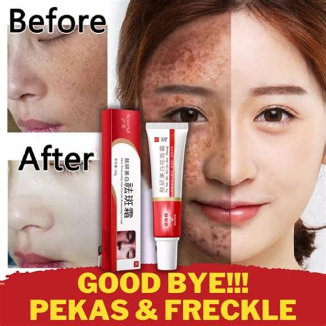 Melasma Cream Pekas Remover Collagen Japan Pekas Remover Original Pekas