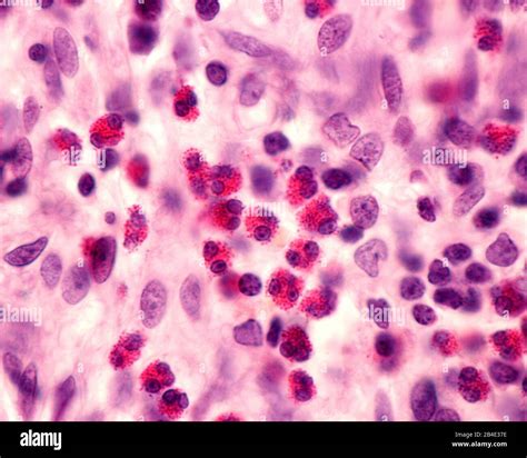 Granulocitos Eosin Filos En Un Infiltrado Inflamatorio Este Tipo De