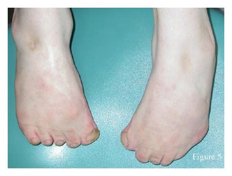 Feet Of The Patient Note Bilateral Talipes Equinovarus Download Scientific Diagram