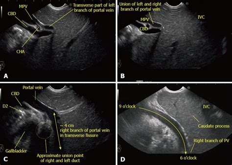 Stepwise Evaluation Of Liver Sectors And Liver Segments By Endoscopic