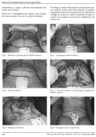 Lipoabdominoplastia Técnica Saldanha PDF