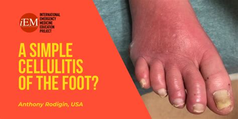 A Simple Cellulitis Of The Foot International Emergency Medicine