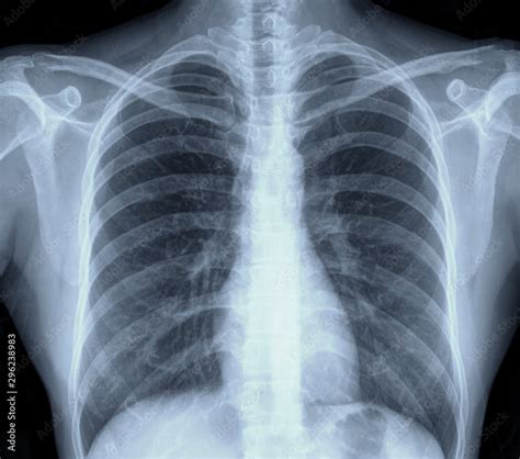 lung chest x-ray images Stock Photo | Adobe Stock