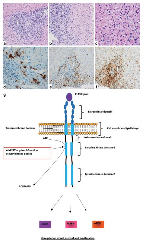 Liver Histology And Putative FLT3 Mutation Mediated Immune Pathways