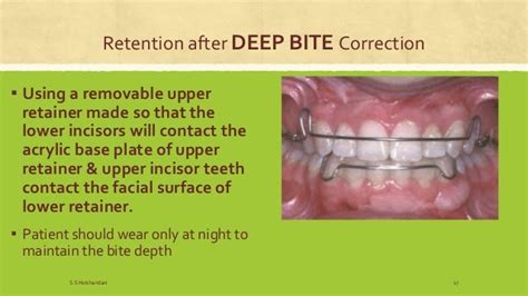 Retention In Orthodontics Dentistry