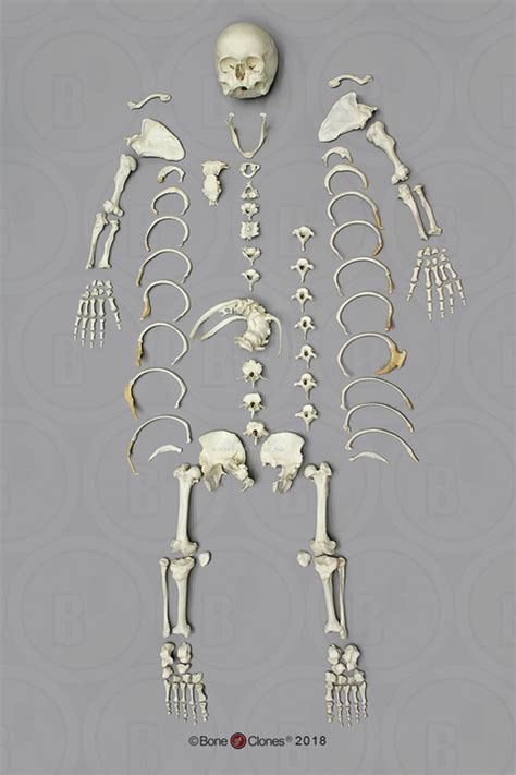 Human Female Achondroplasia Dwarf Skeleton, Disarticulated - Bone ...