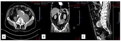 Jcm Free Full Text Same Clinical Reality Of Spontaneous Rupture Of