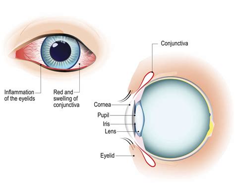 Eye Allergies - Mahnaz Nouri, M.D.