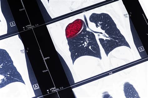 New data on breath biopsy for early detection of lung cancer