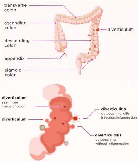 Diverticulitis Vector Illustration Labeled Medical Diagram 59 Off