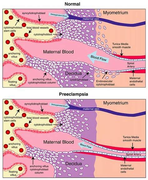 Eclampsia Of Pregnant Women Symptoms Diagnosis And Treatment