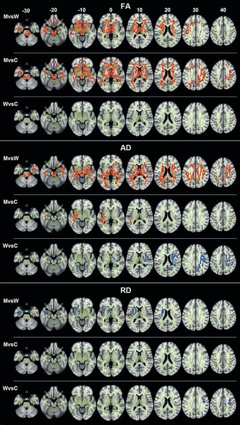 Sex Differences In White Matter Microstructure In The Human Brain