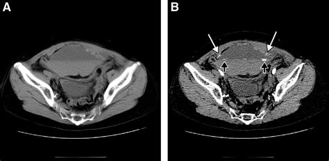 Bilateral Rectus Sheath Hematoma Developing During Anticoagulant