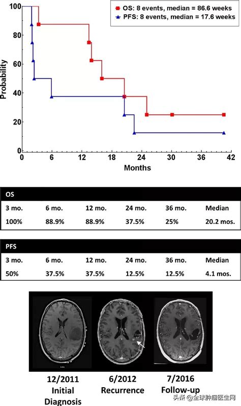 恶性脑瘤也能治好？全球十大新药进展为绝境患者点亮希望母细胞瘤脑胶质瘤替莫唑胺脑瘤新药疫苗疗法治疗 健康界