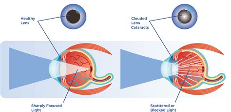 6 Things You Need To Know About Cataracts Eyecarepro Marketing