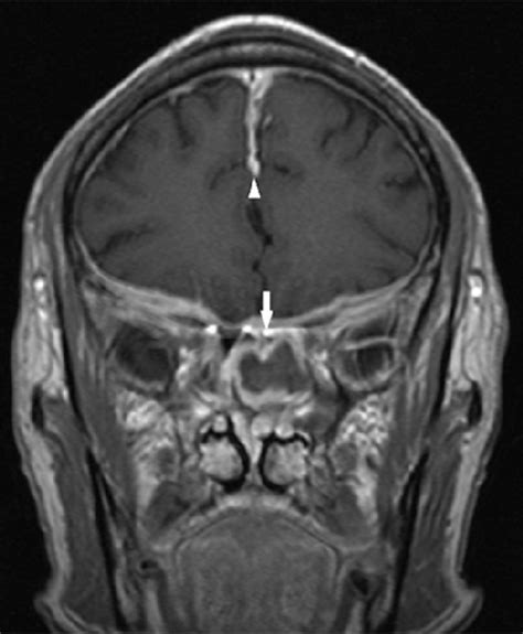 Pdf Sphenoid Sinus Fungus Ball Presenting With Bilateral Visual Disturbance Semantic Scholar