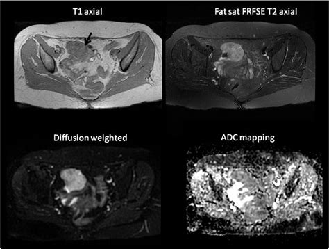 T 1 And T 2 Weighted Axial MRI Scans And Diffusion Weighted B 600