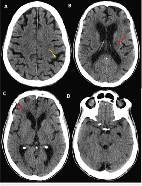 CT Head Without Contrast Of The Patient The Images Show A