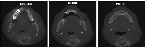 Calcificación Pseudoarticular Del Ligamento Estilohioideo Dento