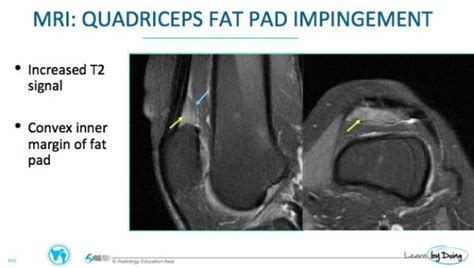 mri knee fat pad impingement radedasia