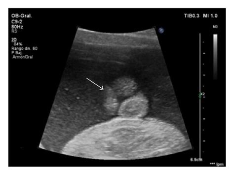 Accurate Diagnosis Of Severe Hypospadias Using D And D Ultrasounds