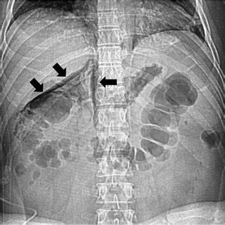 Abdominal Radiograph Of A Patient With Left Colonic Perforation Shows