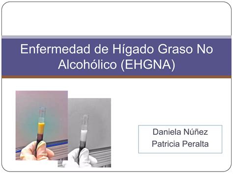 Enfermedad De Hígado Graso No Alcohólico Ppt