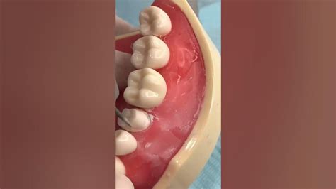 Tooth Prep For A Lower Premolar Crown Dentalshorts Dentalcrowns Dentaleducation Youtube