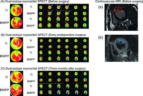 Dual Isotope Myocardial Spect 201 Tl Images Demonstrated Perfusion