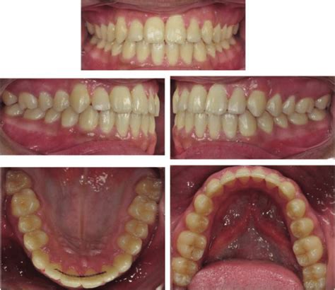 Three Month Review Showing Healing Of The Gingivae Following