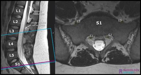 MRI Lumbar Spine