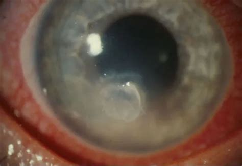 Fungal Keratitis Europe American Academy Of Ophthalmology