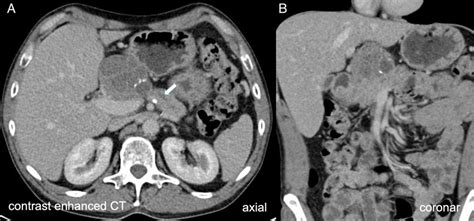 Contrast Enhanced Computed Tomography Ct Scan Revealed A Septated