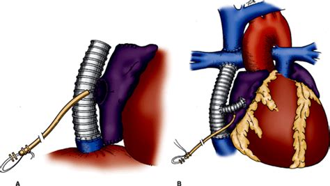 Pulmonary Stenosis And Pulmonary Atresia With Intact Ventricular Septum Abdominal Key