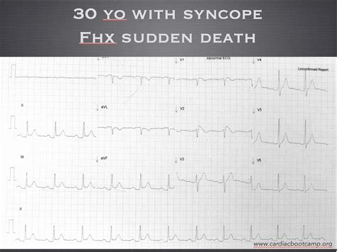 The Patient with syncope: ECG Quiz | Resus