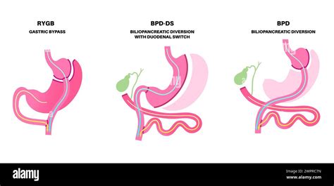 Biliopancreatic Diversion Bpd With Duodenal Switch And Gastric Bypass Stomach Surgery Weight